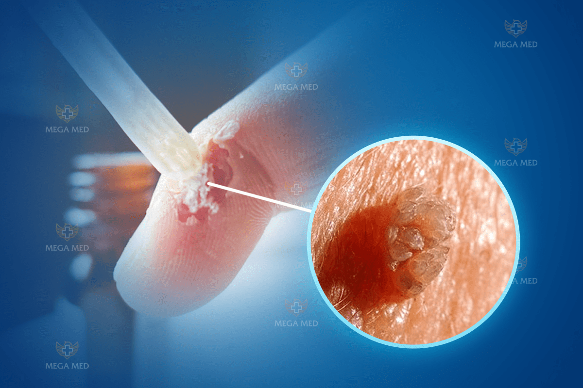 thuốc trị sùi mào gà dạng bôi